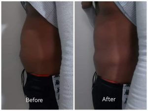 Before and after body contouring result at Aura Fat Freeze Clinic (client 10)