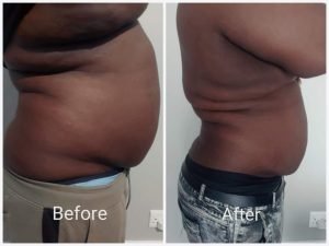 Before and after body contouring result at Aura Fat Freeze Clinic (client 11)