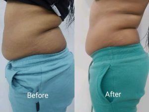 Before and after body contouring result at Aura Fat Freeze Clinic (client 1)