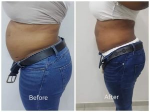 Before and after body contouring result at Aura Fat Freeze Clinic (client 6)