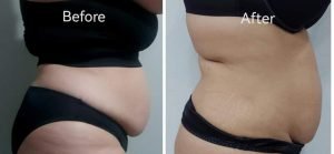Before and after body contouring result at Aura Fat Freeze Clinic (client 7)