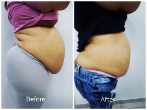 Before and after body contouring result at Aura Fat Freeze Clinic (client 8)