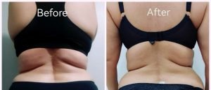 Before and after body contouring result at Aura Fat Freeze Clinic (client 2)