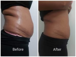 Before and after body contouring result at Aura Fat Freeze Clinic (client 3)