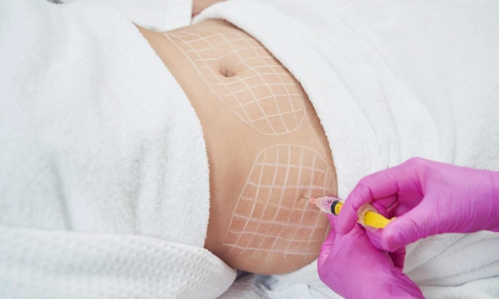 Lipolysis injection treatment on the stomach
